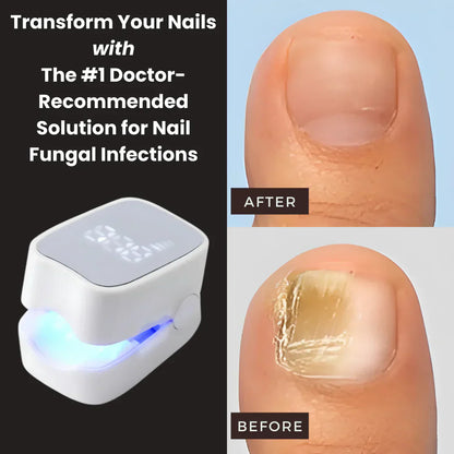NailHeal Pro™ – Nail Fungus Treatment Device