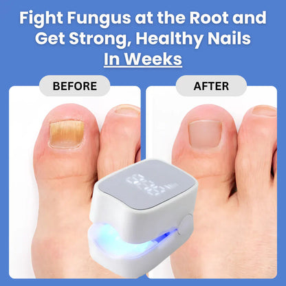 NailHeal Pro™ – Nail Fungus Treatment Device