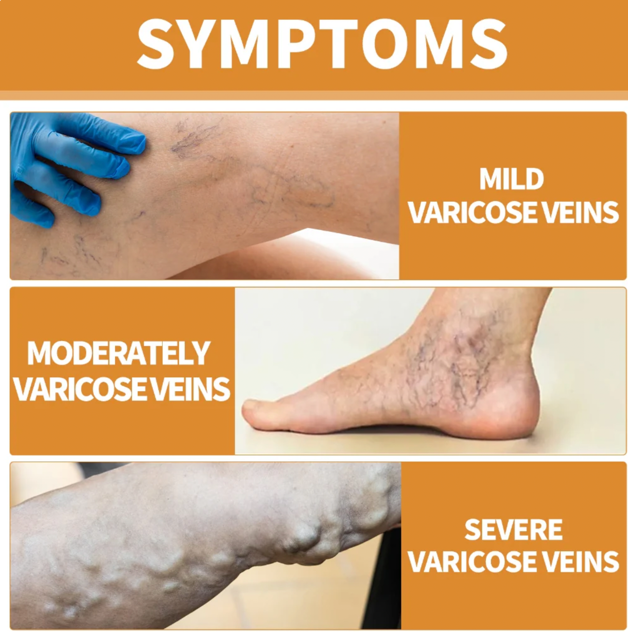 VeinVeda Varicose Vein Relief Spray  (BUY 1 GET 2 FREE)