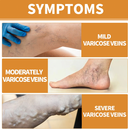 VeinVeda Varicose Vein Relief Spray  (BUY 1 GET 2 FREE)