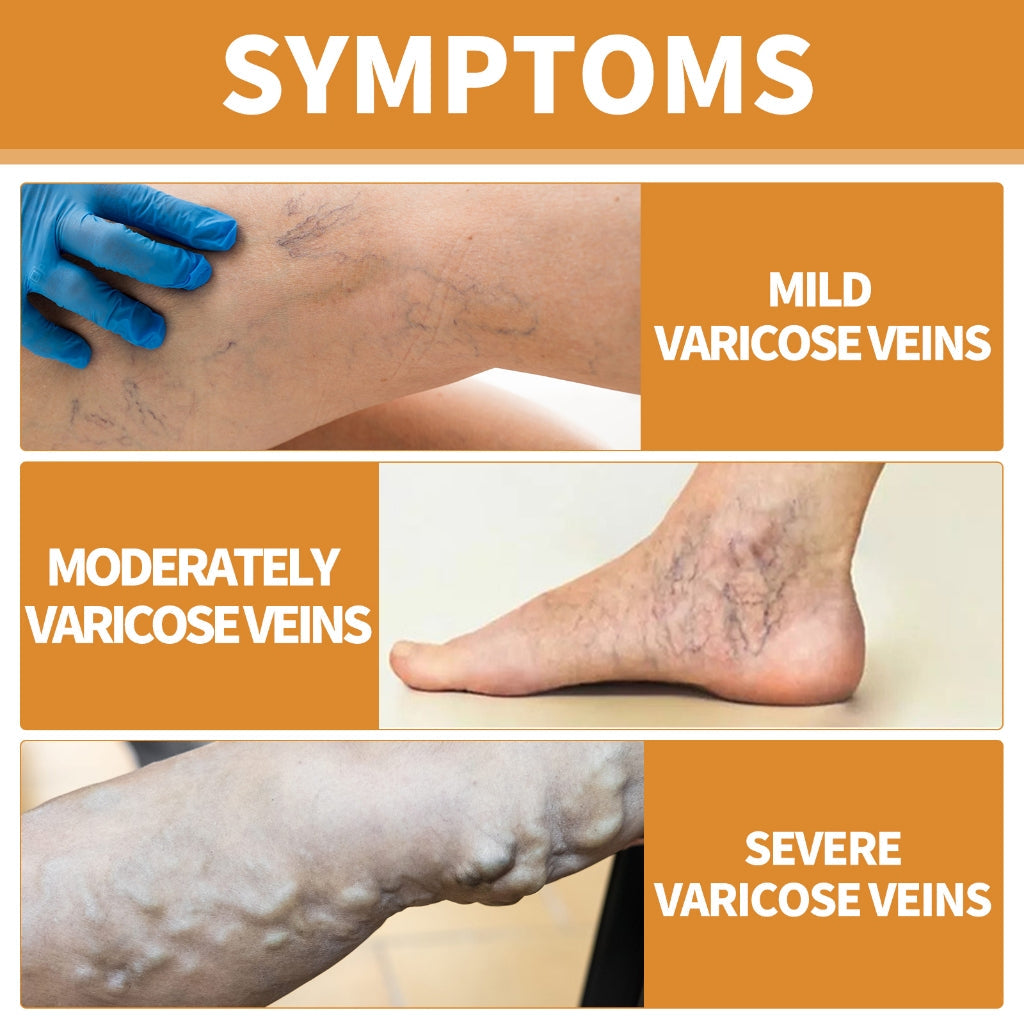VeinVeda™ Varicose Vein Relief Spray ( BUY 1 GET 2 FREE )