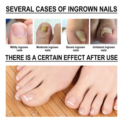 SouthMoon Ingrown Toenail Drops Nail Fungal Repair ( BUY 1 GET 2 FREE )