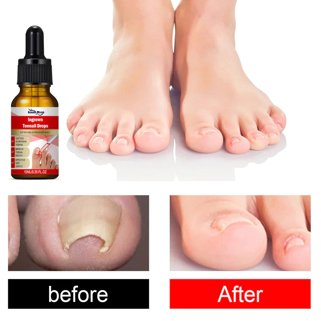 SouthMoon Ingrown Toenail Drops Nail Fungal Repair ( BUY 1 GET 2 FREE )