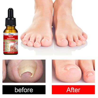 SouthMoon Ingrown Toenail Drops Nail Fungal Repair ( BUY 1 GET 2 FREE )